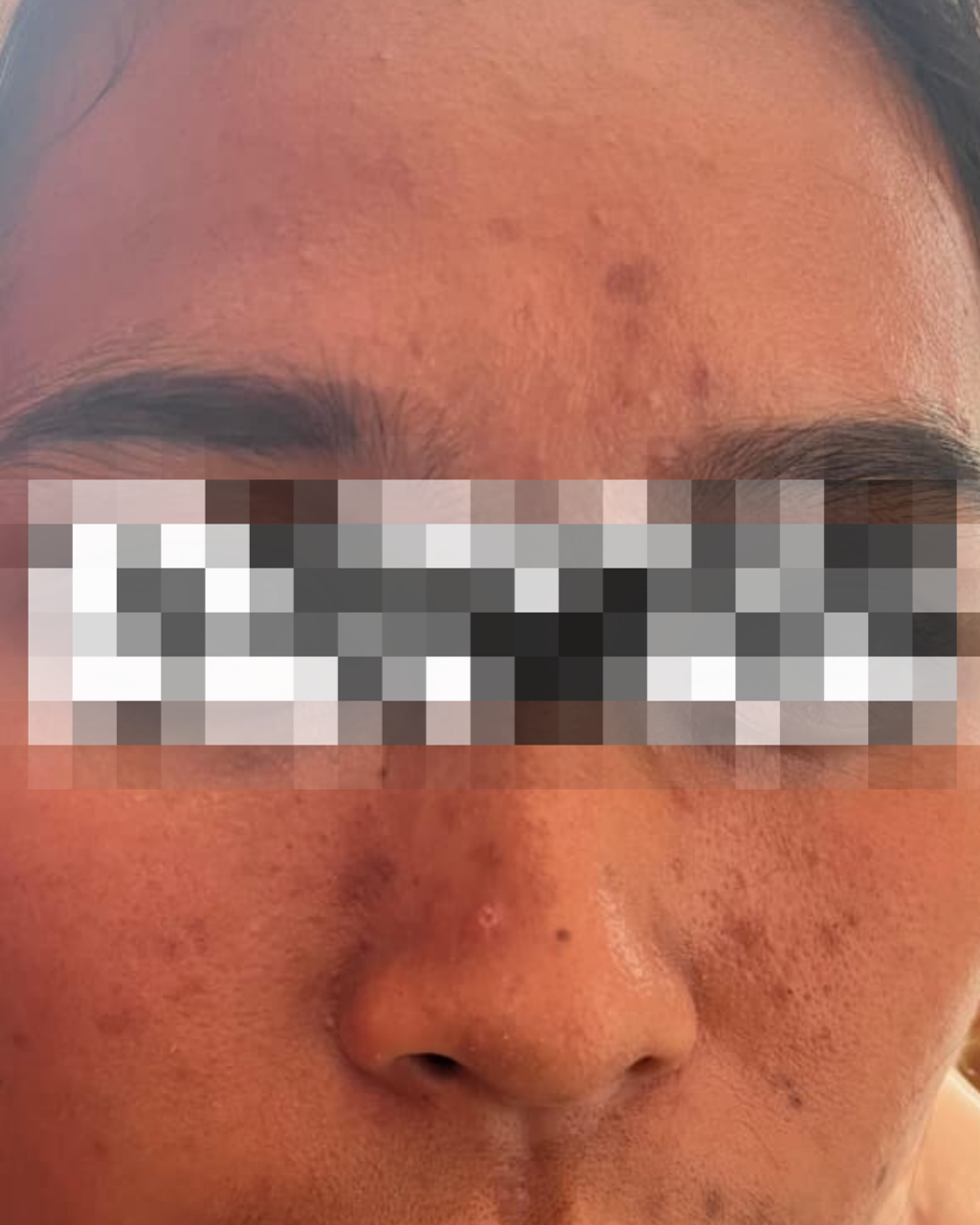 Before Treatment